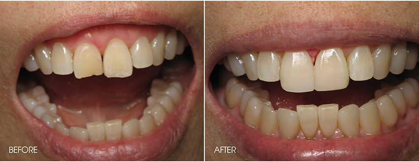 Before & After Photos, Cracked Tooth Repair Gallery