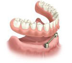 Removable, implant anchored overdenture