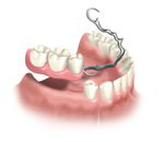 Removable partial denture