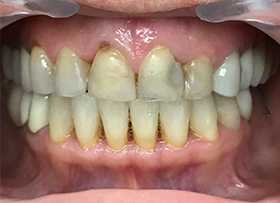 Teeth whitening tustin ca