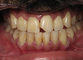 Cosmetic Bonding - tustin dental care ca
