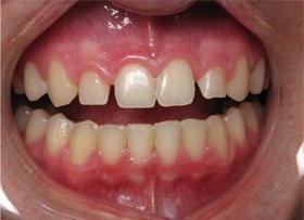 Cosmetic Bonding - tustin dental care ca