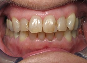 Lumineer Veneers - tustin dental care ca