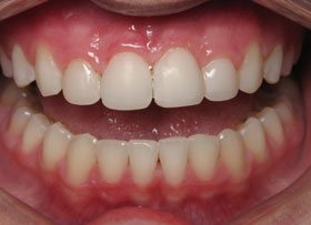 Cosmetic Bonding - tustin dental care ca