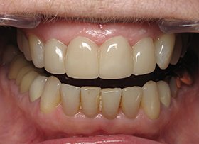 Lumineer Veneers - tustin dental care ca