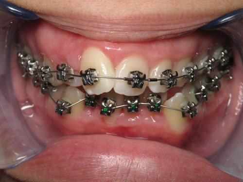 Stage 2 - dental treatment in tustin