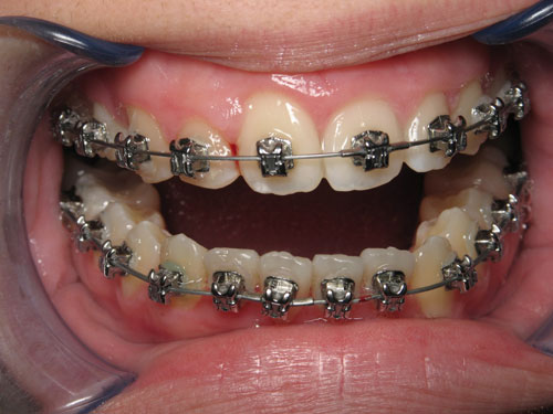 Stage 3 - tustin dental care ca