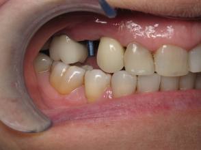 Stage 2 - dental treatment in tustin